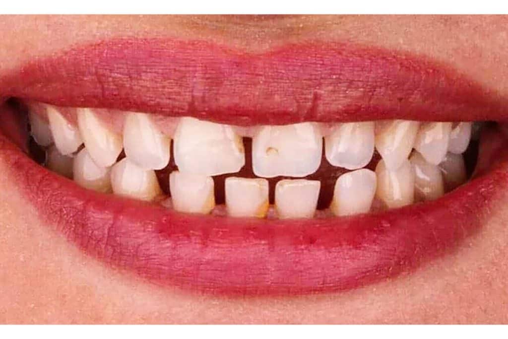 Für ein schönes Lächeln gibt es jetzt Zahnimplantat!