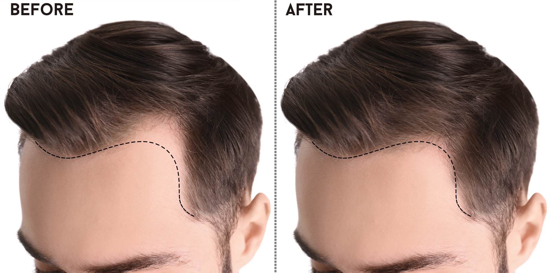 Was Kostet Eine Haartransplantation In Polen Meistverkaufte Haartransplantation Kosten -ab 2000 Euro?