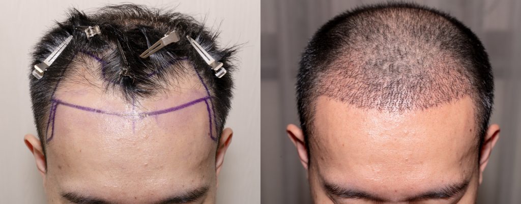 Meistverkaufte Haartransplantation Kosten