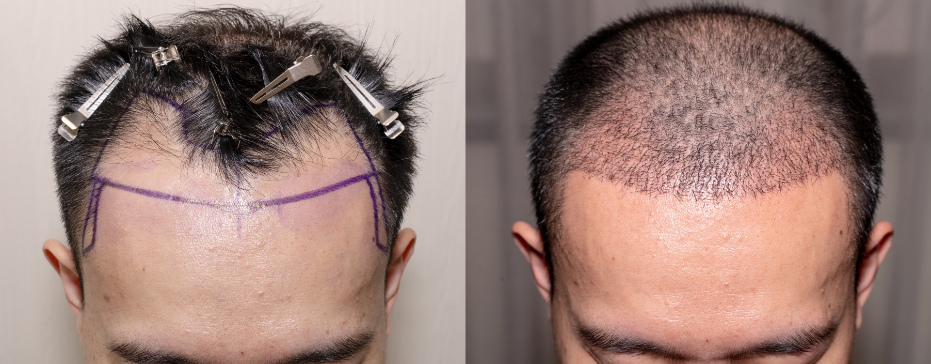 Was Kostet Eine Haartransplantation In Polen Meistverkaufte Haartransplantation Kosten -ab 2000 Euro?