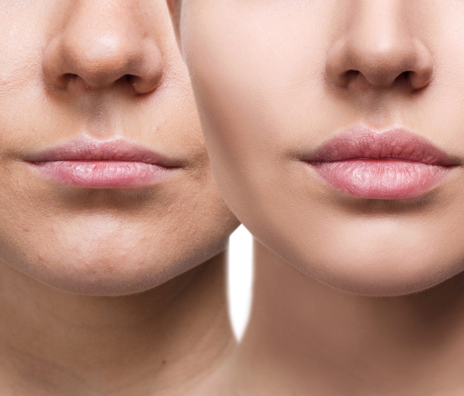 Lippen aufspritzen vorher nachher mit 15 Bilder