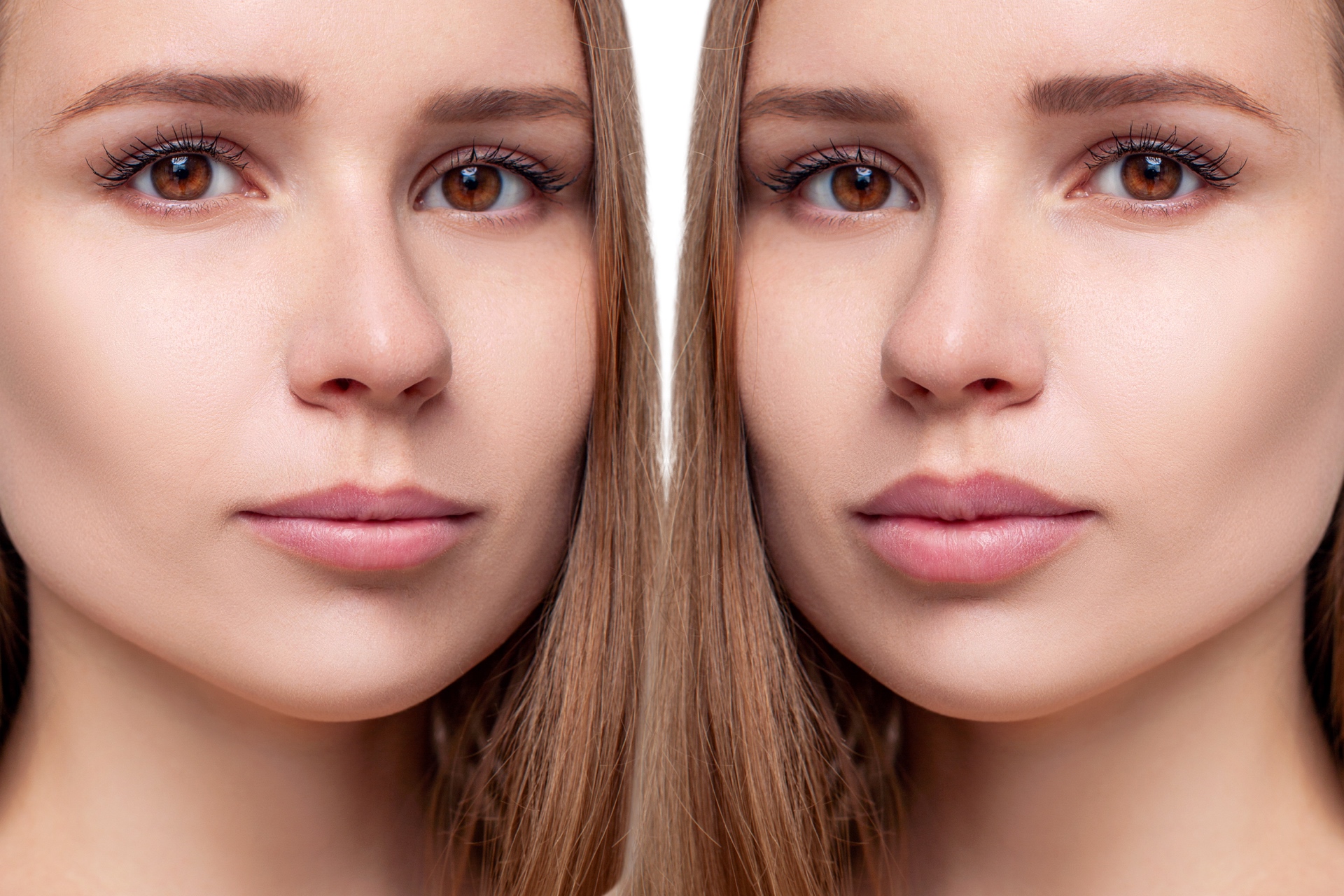 Lippen Aufspritzen 0 5 Ml Vorher Nachher Lippen aufspritzen vorher nachher mit 15 Bilder