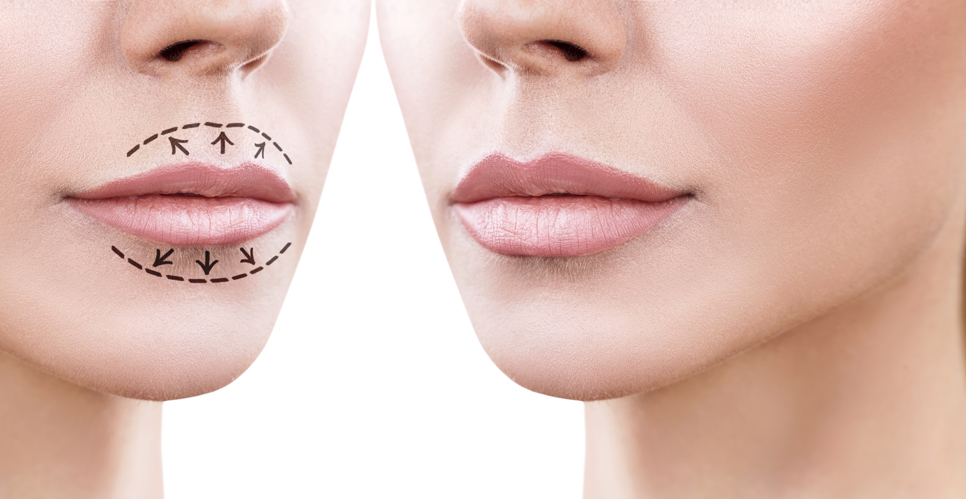 Lippen aufspritzen vorher nachher mit 15 Bilder