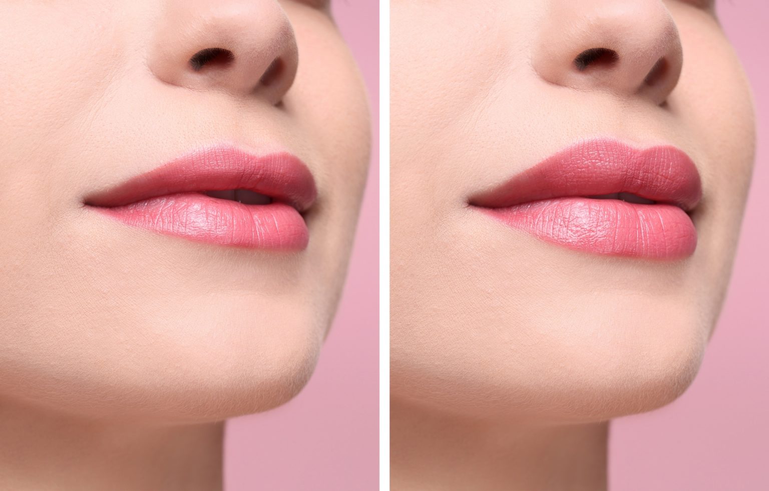Lippen aufspritzen vorher nachher mit 15 Bilder