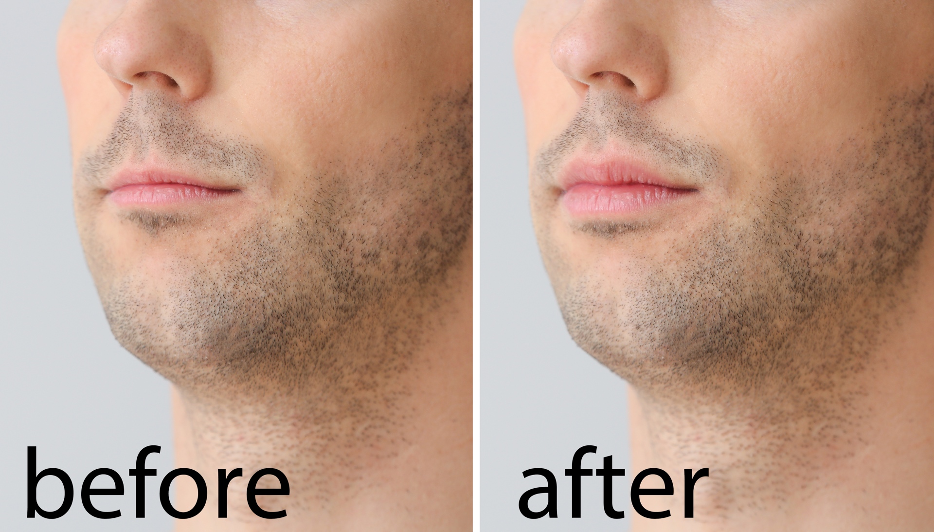 lippen 0 5 ml vorher nachher