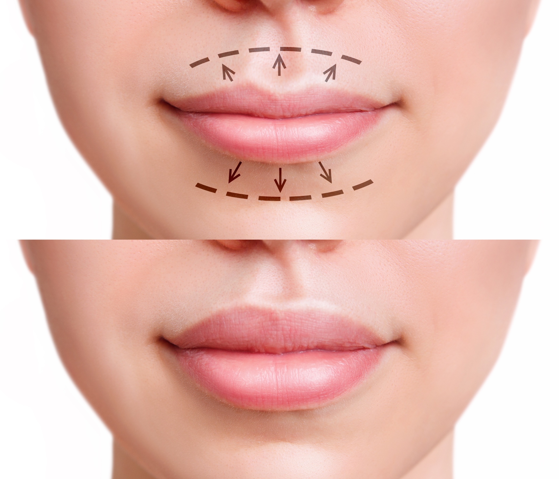 lippen-aufspritzen-vorher-nachher-mit-15-bilder