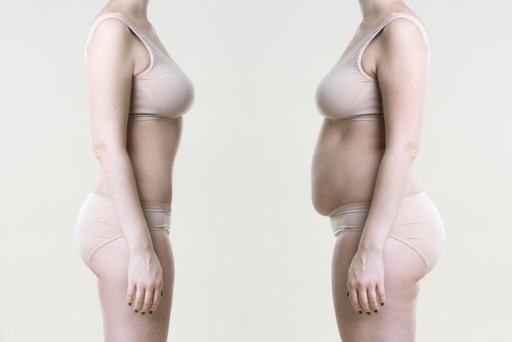 Fettabsaugung Bauch vorher nachher Bilder