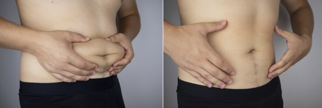 Fettabsaugung Bauch vorher nachher Bilder